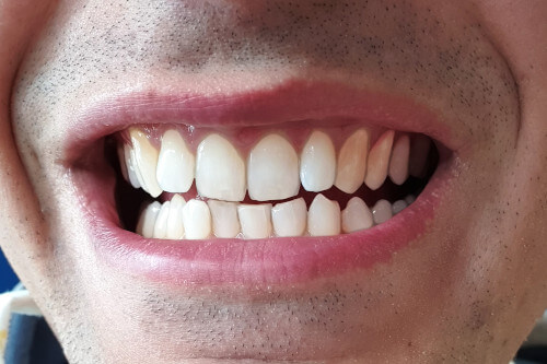 Rendere bianchi i denti con gimp dopo